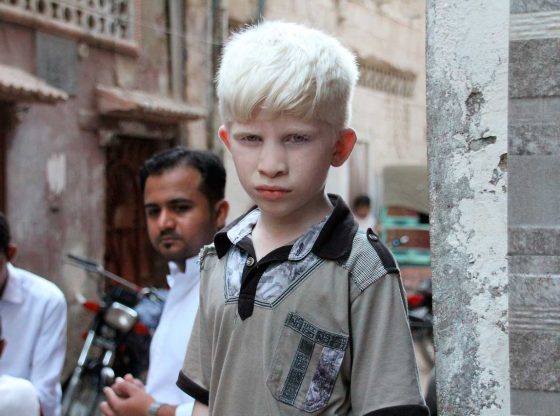 Rafael-Nunez-Aponte-El-albinismo-como-causa-de-bullying-escolar